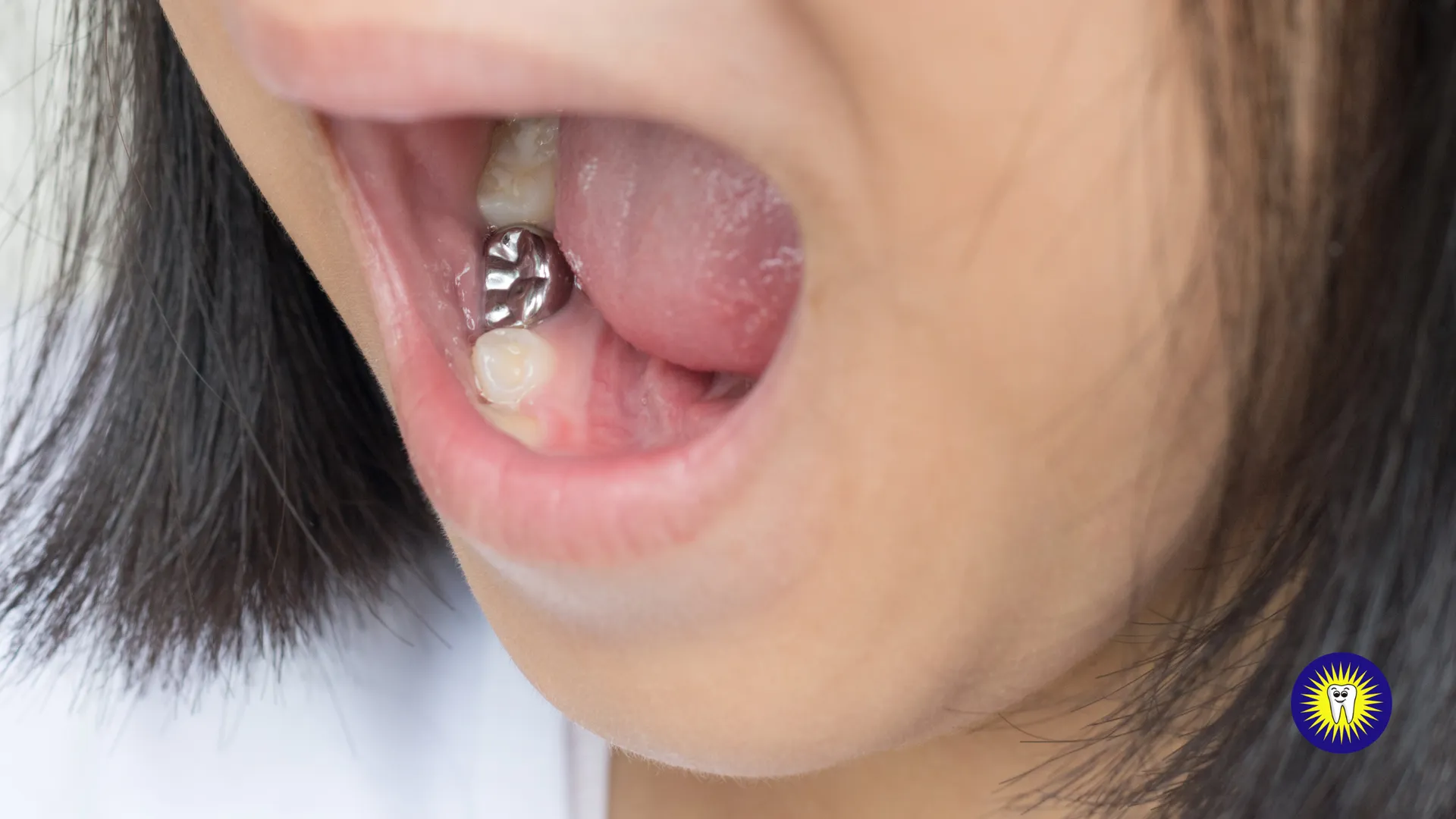 Different Types of Dental Crowns in Toronto and Scarborough