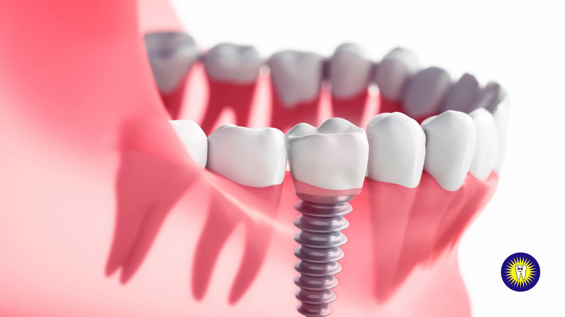 Should I replace my missing teeth with dental implants in Toronto