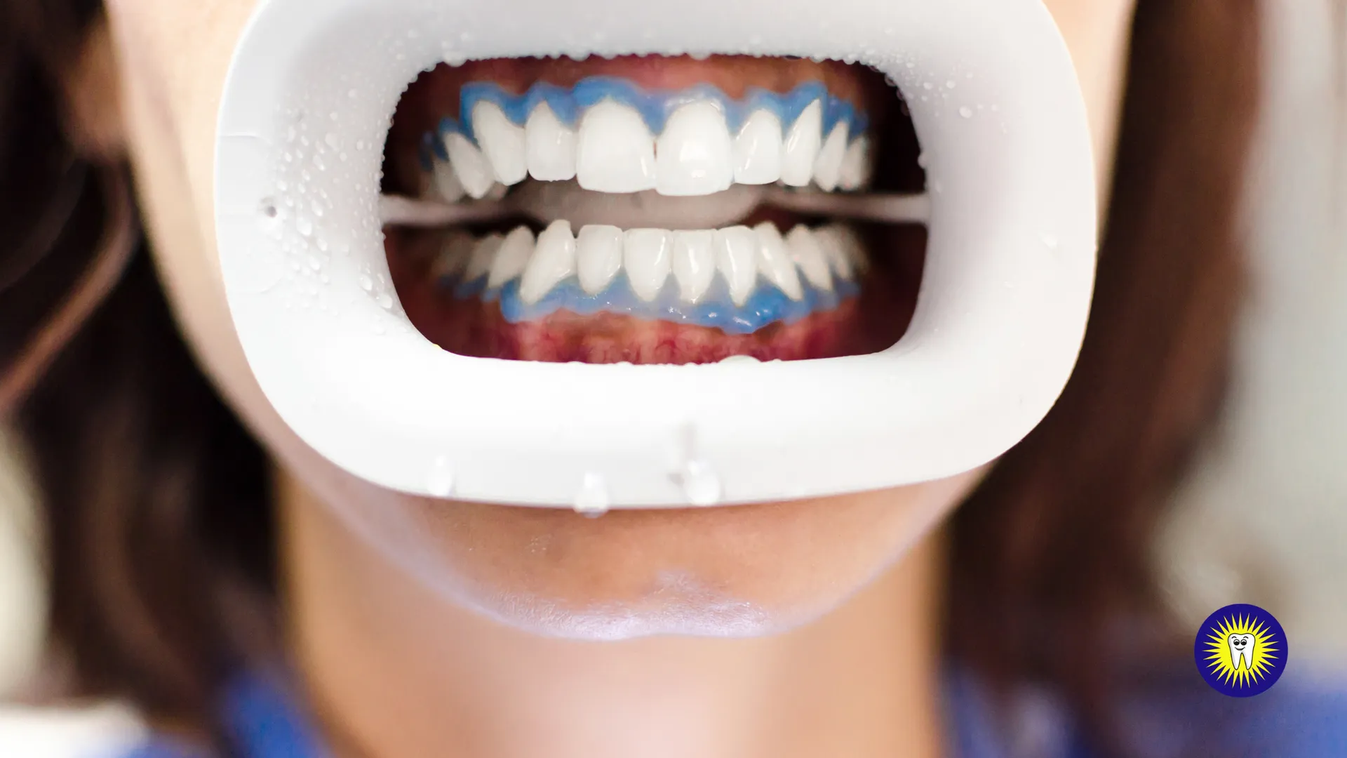 What to expect during a teeth whitening treatment