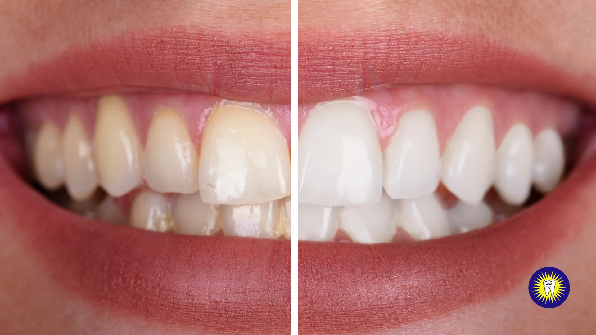 Teeth whitening services and solutions in Toronto